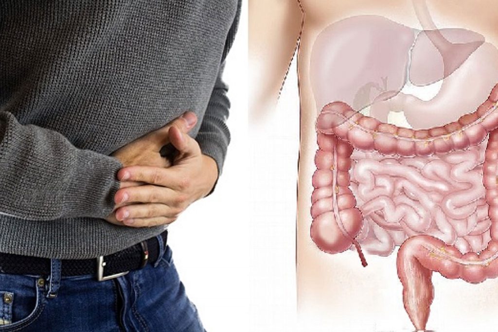 Morbo Di Crohn Si Può Morire